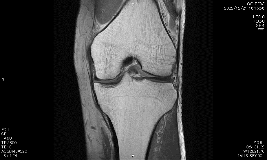膝関節MRI　プロトン強調画像