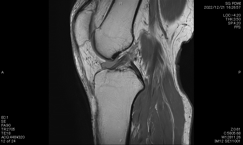 膝関節MRI　プロトン強調画像