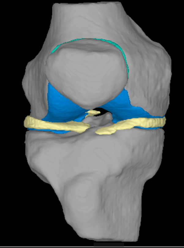 膝関節解析　3D画像